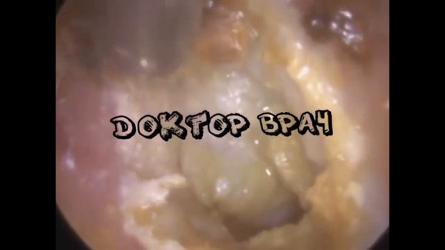 УХО ПЕРЕПОЛНЕНО УШНОЙ СЕРОЙ! СМОТРЕТЬ ВСЕМ! [2 ВЫПУСК] [Доктор Врач] смотреть онлайн