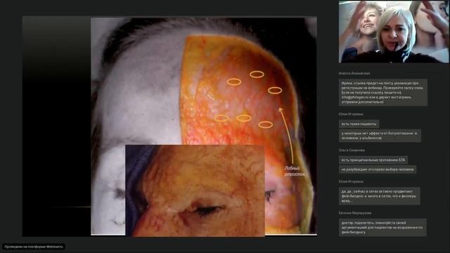 Верхняя треть лица. Морщины лба. Возможность коррекции без БТА.