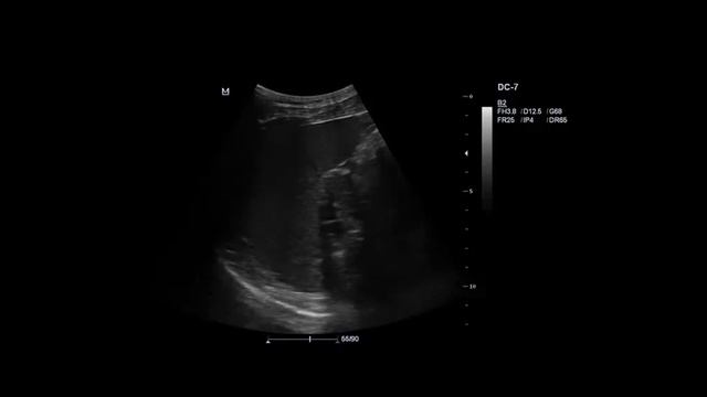 УЗИ матки.mp4 смотреть онлайн