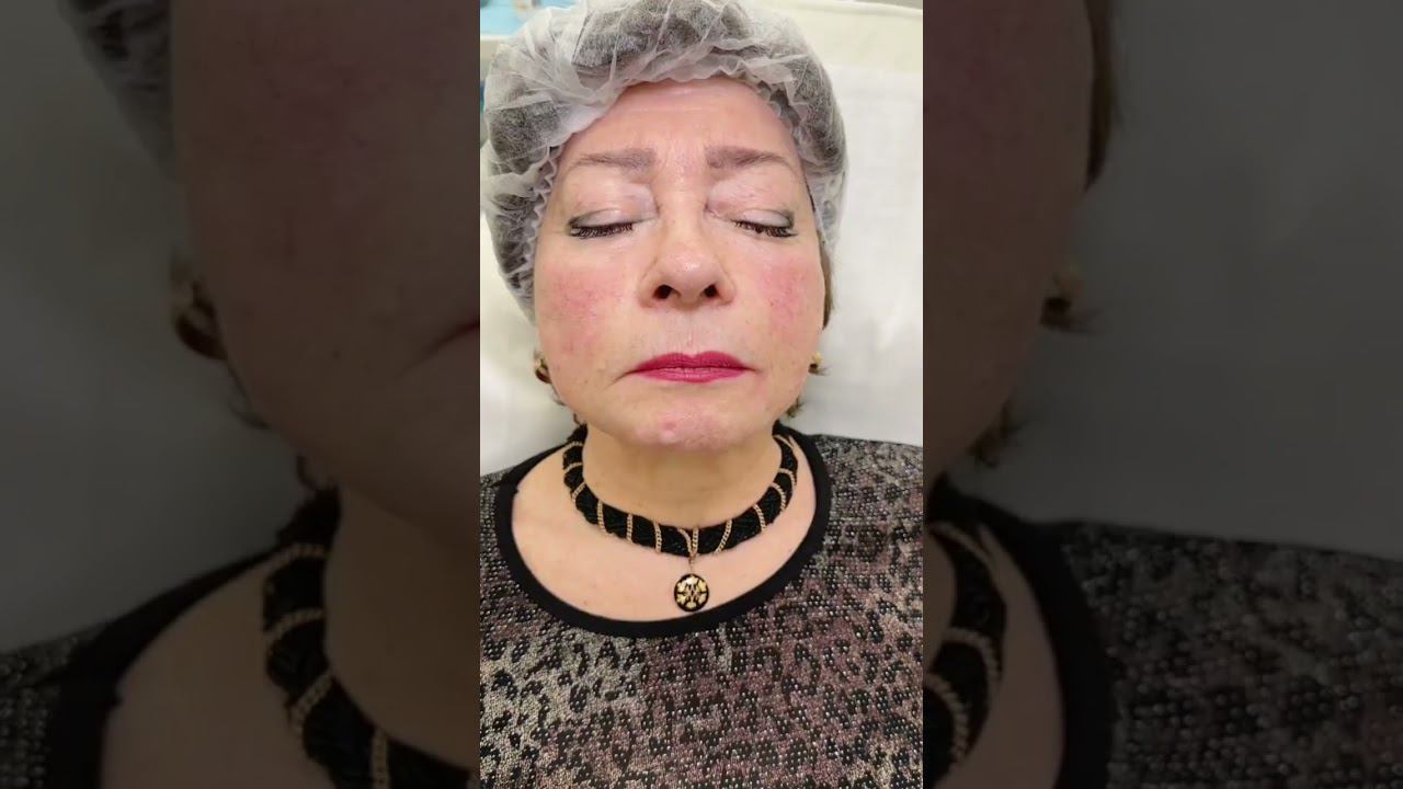 Коррекция опущенных уголков губ, врач-дерматокосметолог Ирина Николаевна Прилепина. смотреть онлайн