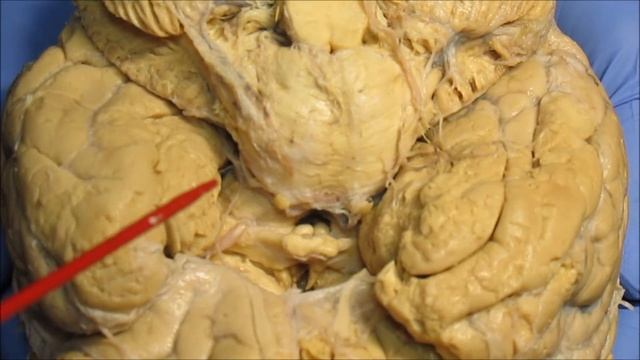 Основание мозга. Продолговатый мозг. Задний мозг, мост, мозжечок смотреть онлайн