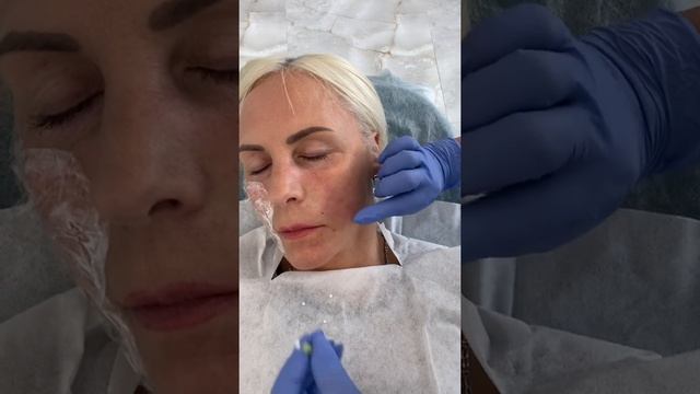 Juoko ( Nasolabialinių) Raukšlių Mažinimas Su Mezo Siūlais