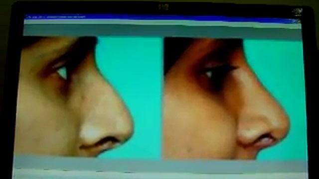 عملية تجميل الانف-جراحة تجميل الانف-المنخار-rhinoplasty pictures смотреть онлайн