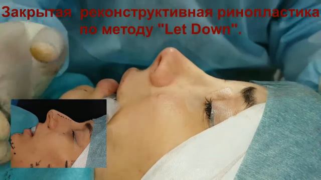 Новая техника закрытой ринопластика по методике "Let Down" смотреть онлайн