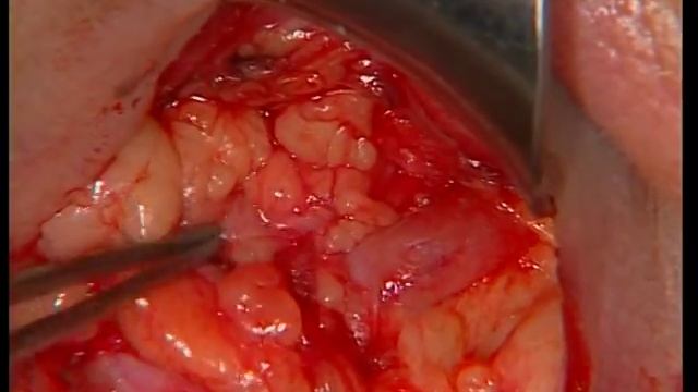 Эстетическая блефаропластика by Dr Darina Krastinova смотреть онлайн