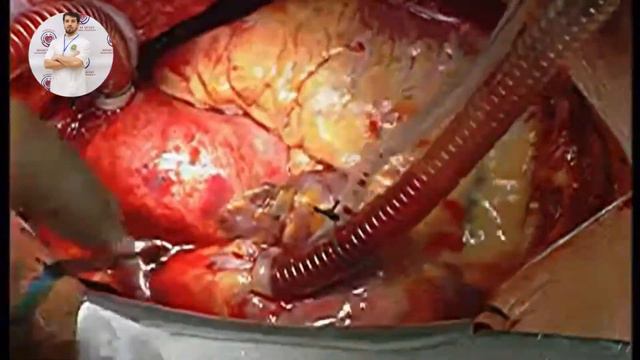 Канюляция верхней и нижней полых вен смотреть онлайн