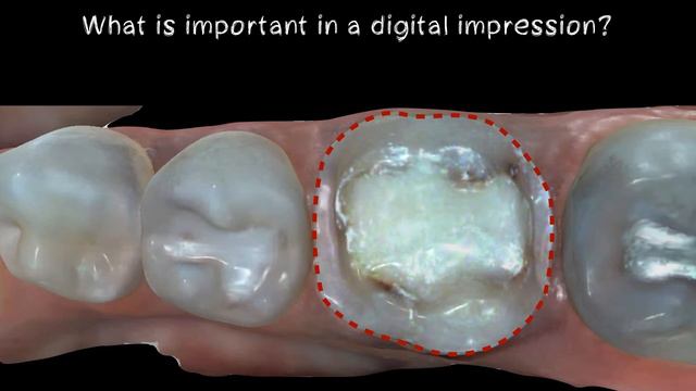Single-unit restoration by Dr Anthony Mennito смотреть онлайн