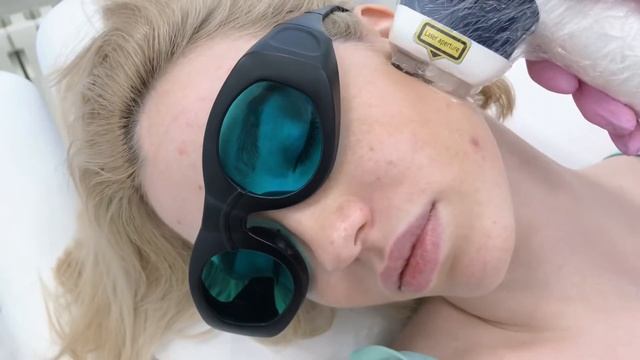 Лазерная эпиляция бакенбардов/висков смотреть онлайн