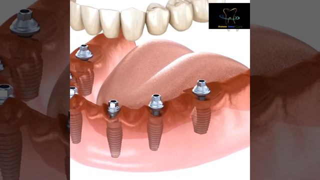 #dental #implantesdentarios #treatment #pain #bridges #advice #braces смотреть онлайн