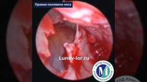 Удаление кисты из верхнечелюстной пазухи с помощью пьезотома.