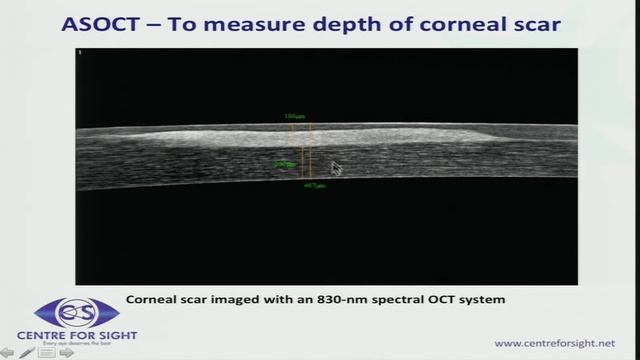AIOC2018 - GP005 - Topic - OCT : Role in Corneal and Refractive Disorders - Dr.Hemlata Gupta смотреть онлайн