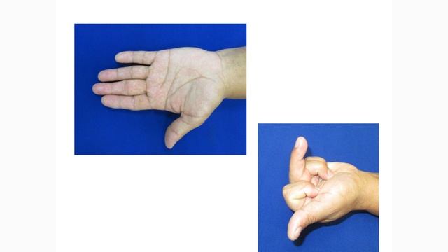 Контрактуры пальцев кисти. Глеб Микусев. смотреть онлайн