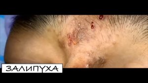 ВЫДАВЛИВАНИЕ ПРЫЩЕЙ. ВЫДАВЛИВАНИЕ ЧЕРНЫХ ТОЧЕК. УДАЛЕНИЕ И ВЫДАВЛИВАНИЕ ЧЕРНЫХ ТОЧЕК.УДАЛЕНИЕ ПРЫЩЕ