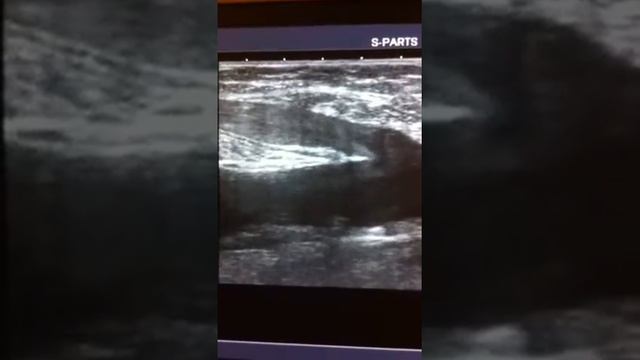 Вальсальва минус смотреть онлайн