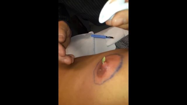 БОЛЬШОЙ ЧИРЕЙ/БОЛЬШОЙ ЧИРЯК/БОЛЬШОЙ ПРЫЩ/БОЛЬШОЙ ГНОЙНИК