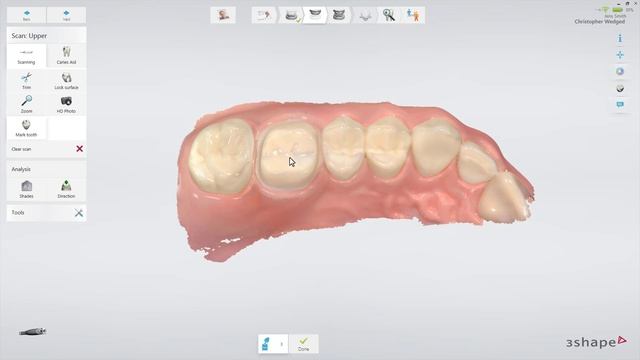 3Shape TRIOS - Crown Workflow смотреть онлайн