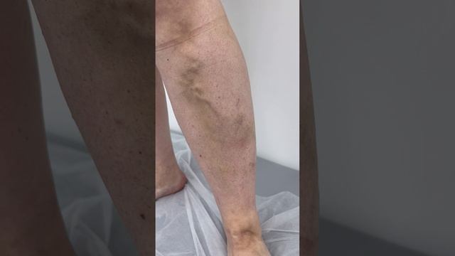 Варикозные Вены. Осмотр флеболога в Москве. Флеболог Москва. Сосудистый хирург