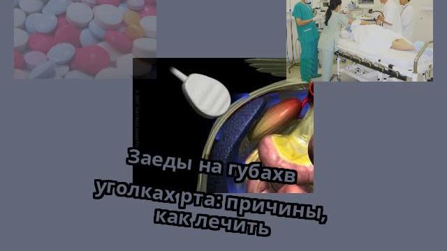 Заеды на губахв уголках рта: причины, как лечить смотреть онлайн