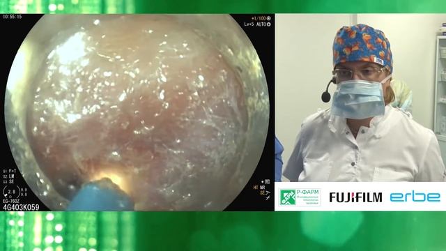 Эндоскопическая диссекция латерально-распространяющейся опухоли прямой кишки. К. В. Шишин смотреть онлайн