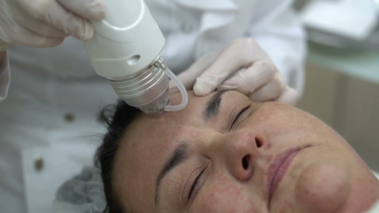 Микроигольчатый RF-лифтинг Inus смотреть онлайн