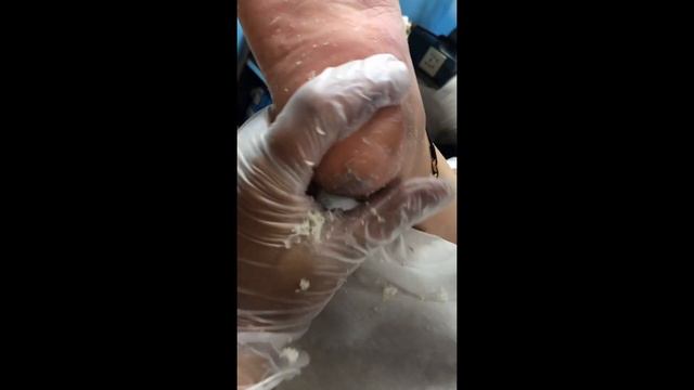 The dead skin on the soles of the feet is scraped off like snowflakes【Foot Scalpel】 смотреть онлайн