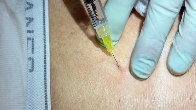 Large Blackheads Extracted. DPOWs Packed Full Of Content Expressed. Spectrum Of Blackheads Displaye