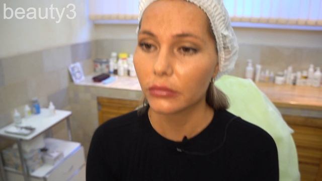 Увеличим губы и посмотрим результат (+Ботокс в лоб и уголки губ) смотреть онлайн