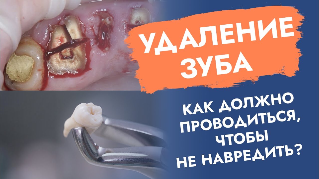 Удаление зуба. Операция. Как проходит, чтобы не навредить? смотреть онлайн