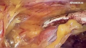 Лапароскопия при спаечном процессе в брюшной полости