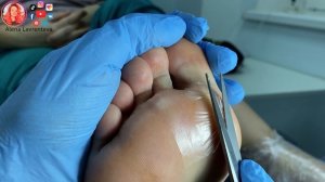 Стержневая мозоль на стопе ? / Почему появляются мозоли?