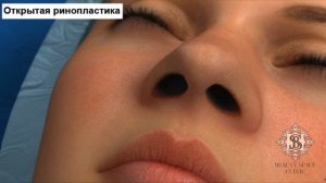 Как проводится ринопластика?