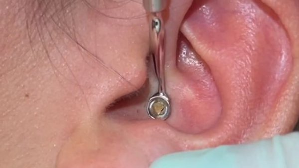 Acne Extractions! Large Blackheads and whiteheads in the ears and on the lips. MrPopZit