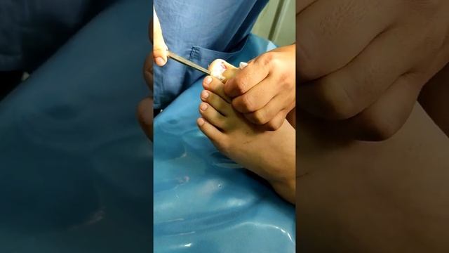 Удаление ногтя. смотреть онлайн