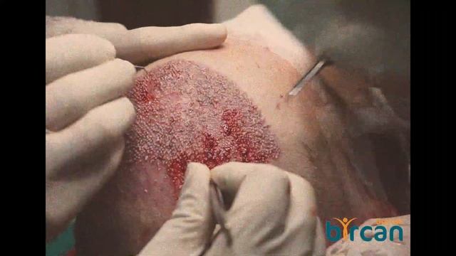 РЕЗУЛЬТАТ ПЕРЕСАДКИ ВОЛОС СПУСТЯ 6 МЕСЯЦЕВ L FUE HAIR TRANSPLANT RESULTS AFTER 6 MONTHS