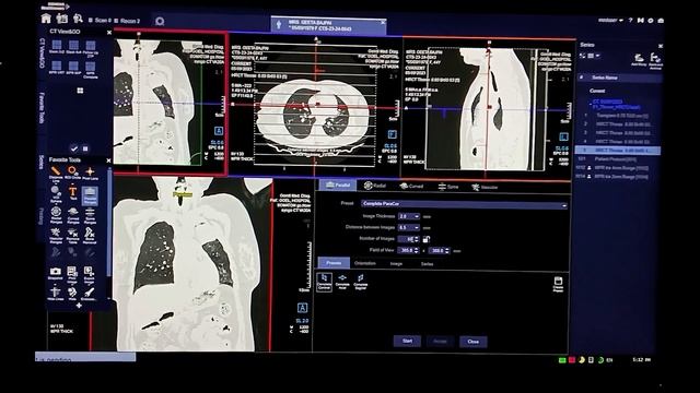 HRCT Thorax | CT scan of chest | chest scan | old TB TB patients смотреть онлайн