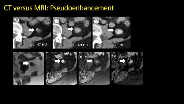 CT and MRI of renal masses смотреть онлайн