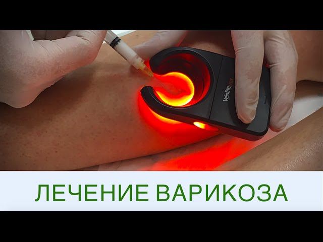 Склеротерапия в Клинике "Градиент" смотреть онлайн