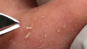 角栓 ブラックヘッド 角栓除去 ニキビ芯出し | ーニキビ #にきび治療    #BlackHeads #Whiteheads  #Acnes    #Dr.Somaria