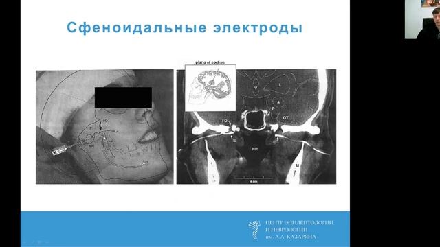 Опыт использования дополнительных электродов при продолженном видео-ЭЭГ мониторинге. Троицкий А.А. смотреть онлайн