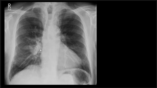 Chest Imaging Made Easy Course : Lecture 09 : Hidden Areas in CXR смотреть онлайн