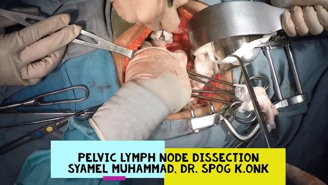 Pelvic Lymph Node Dissection for Cervical Cancer смотреть онлайн