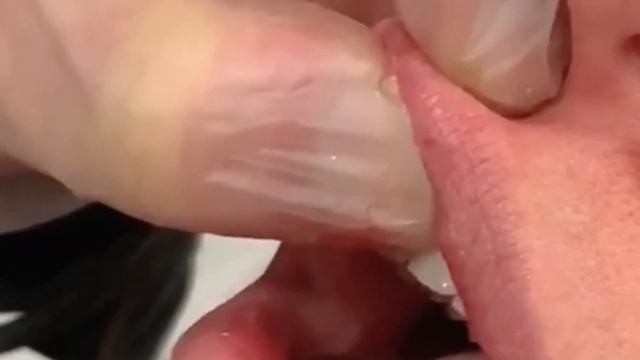 Lip Filler Correction at Simply Clinics смотреть онлайн