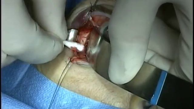 Lateral canthotomy incision for access to lateral orbit смотреть онлайн