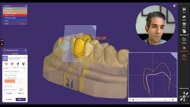exocad Latest Features: Minimum Thickness Options смотреть онлайн