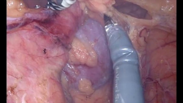 Robotic Partial Intersphincteric resection