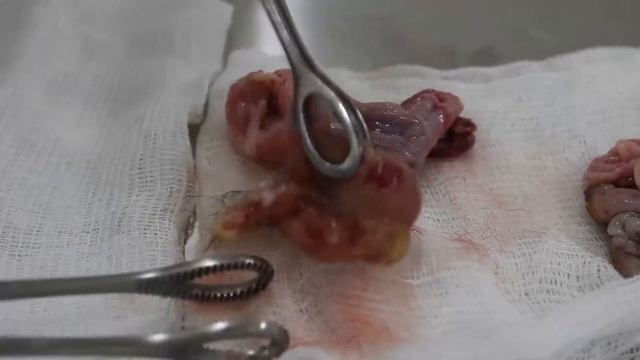 Что внутри дермоидной кисты яичника? Макропрепарат.