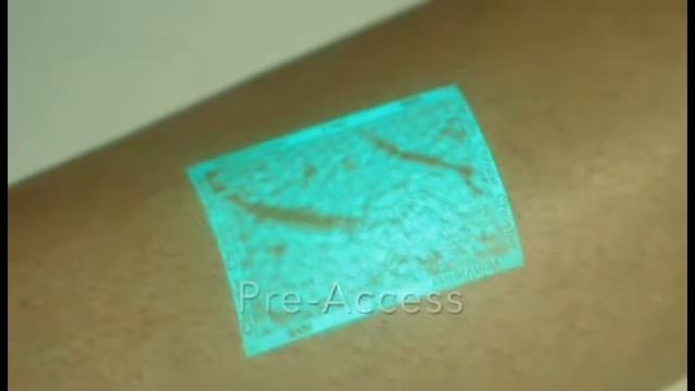 Диагностика вен перед инъекциями при помощи VeinViewer веновизора смотреть онлайн