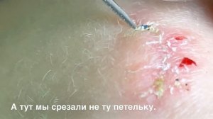 Как самостоятельно снять швы в домашних условиях. Что для этого нужно?