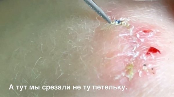 Как самостоятельно снять швы в домашних условиях. Что для этого нужно?