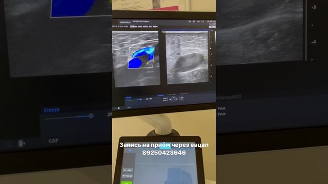 Варикоз на ноге. Лечение варикоза. Узи вен. Узи сосудов. Сосудистый хирург Москва. Флеболог Москва смотреть онлайн